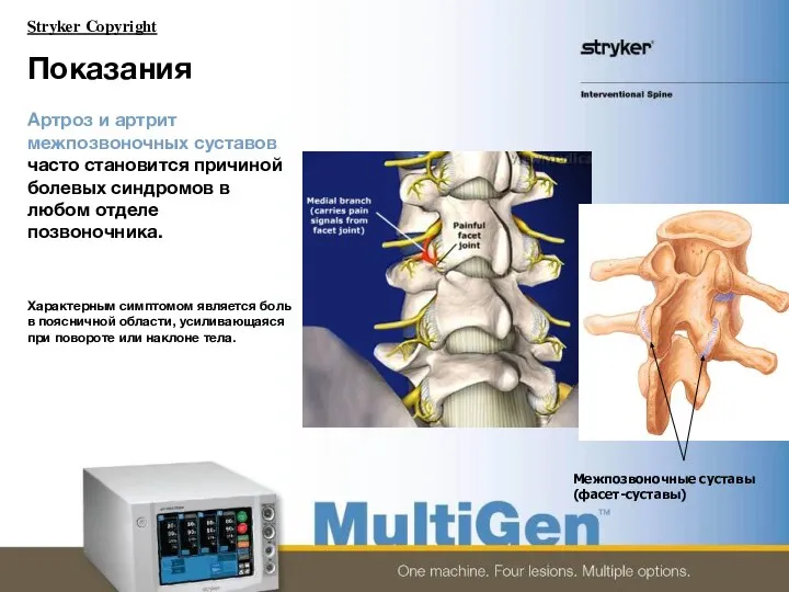 Показания Артроз и артрит межпозвоночных суставов часто становится причиной болевых синдромов в