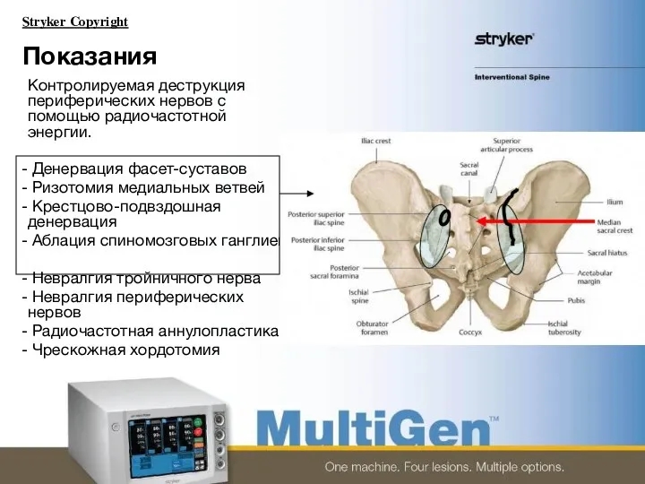 Показания Контролируемая деструкция периферических нервов с помощью радиочастотной энергии. Денервация фасет-суставов Ризотомия