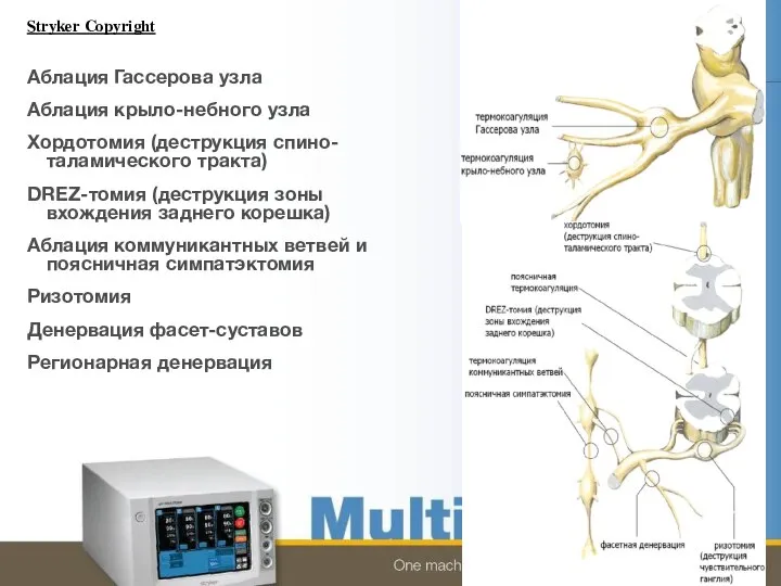 Аблация Гассерова узла Аблация крыло-небного узла Хордотомия (деструкция спино-таламического тракта) DREZ-томия (деструкция