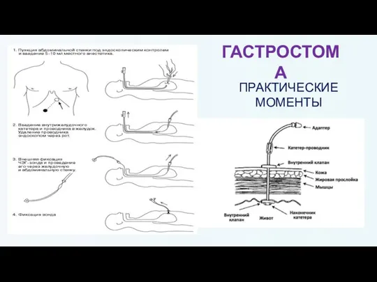 ГАСТРОСТОМА ПРАКТИЧЕСКИЕ МОМЕНТЫ