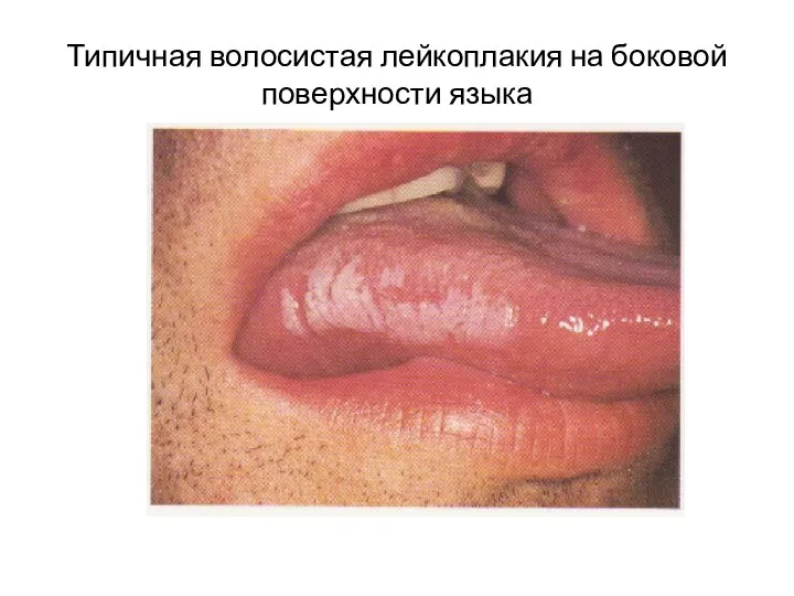 Типичная волосистая лейкоплакия на боковой поверхности языка