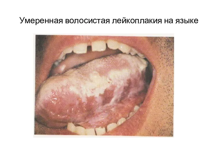 Умеренная волосистая лейкоплакия на языке