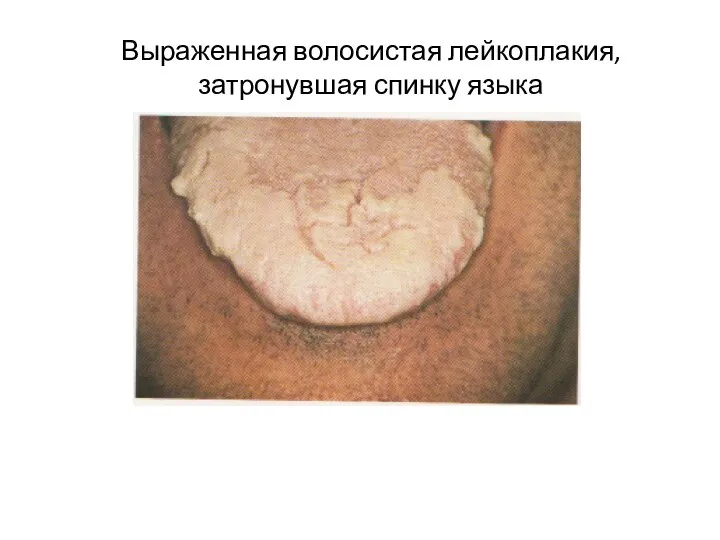 Выраженная волосистая лейкоплакия, затронувшая спинку языка