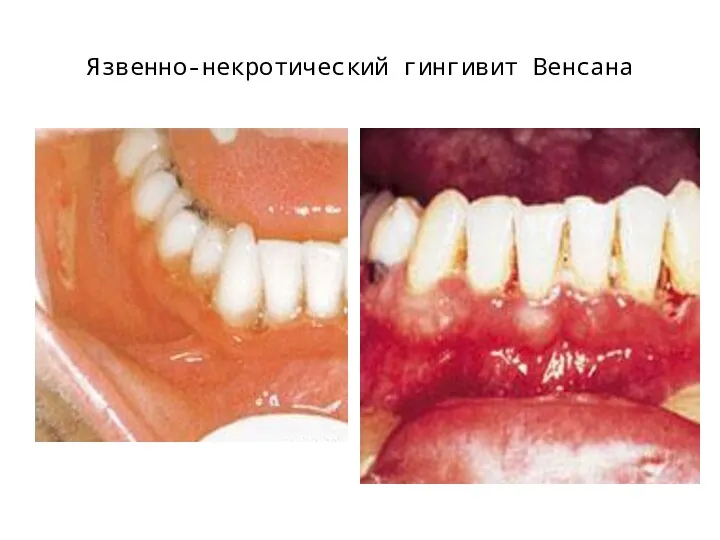 Язвенно-некротический гингивит Венсана