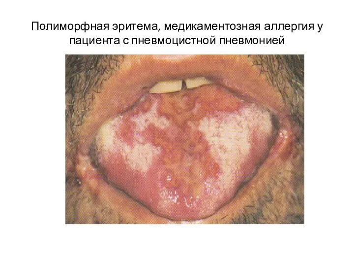 Полиморфная эритема, медикаментозная аллергия у пациента с пневмоцистной пневмонией