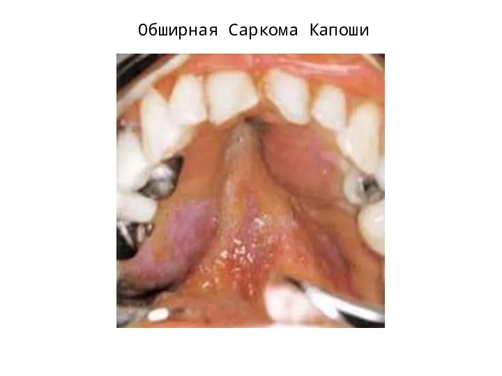 Обширная Саркома Капоши