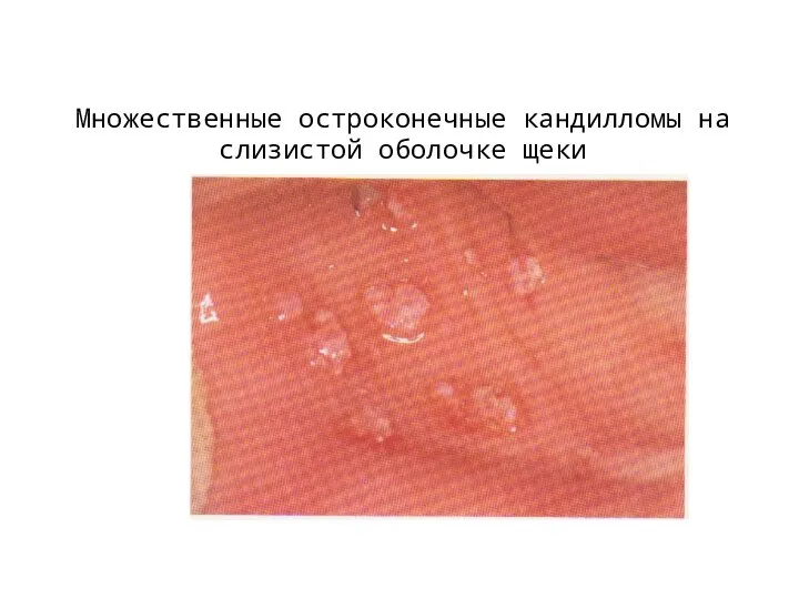 Множественные остроконечные кандилломы на слизистой оболочке щеки