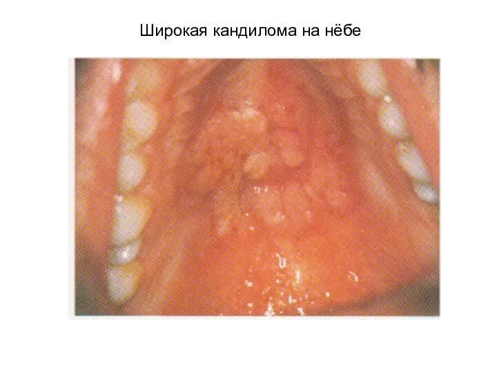 Широкая кандилома на нёбе