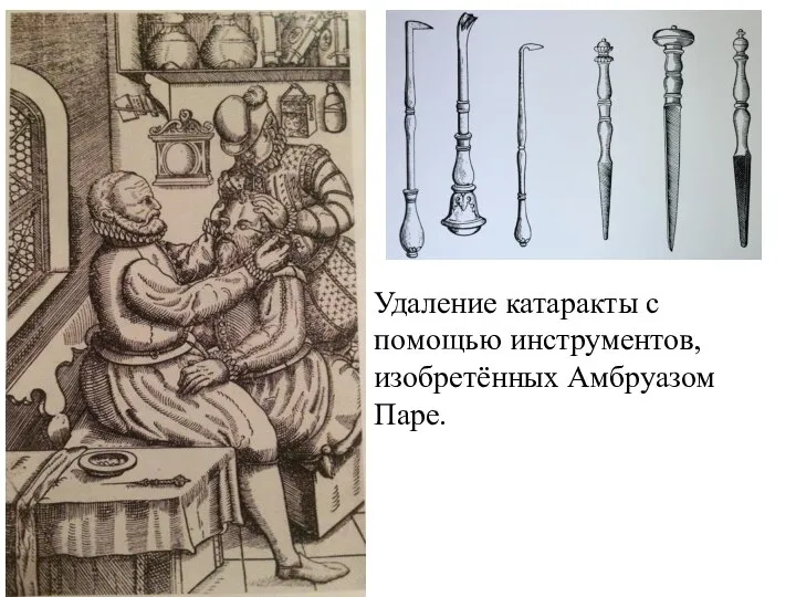 Удаление катаракты с помощью инструментов, изобретённых Амбруазом Паре.
