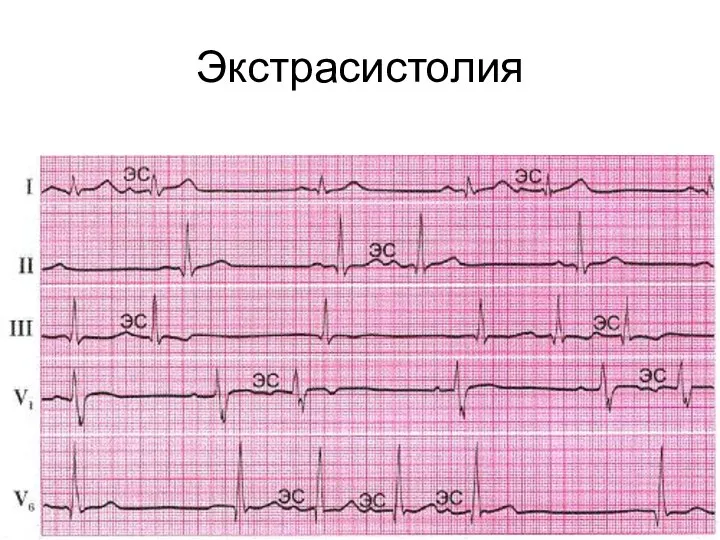 Экстрасистолия