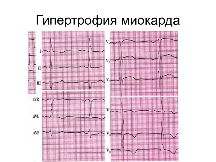 Гипертрофия миокарда