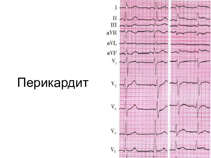 Перикардит