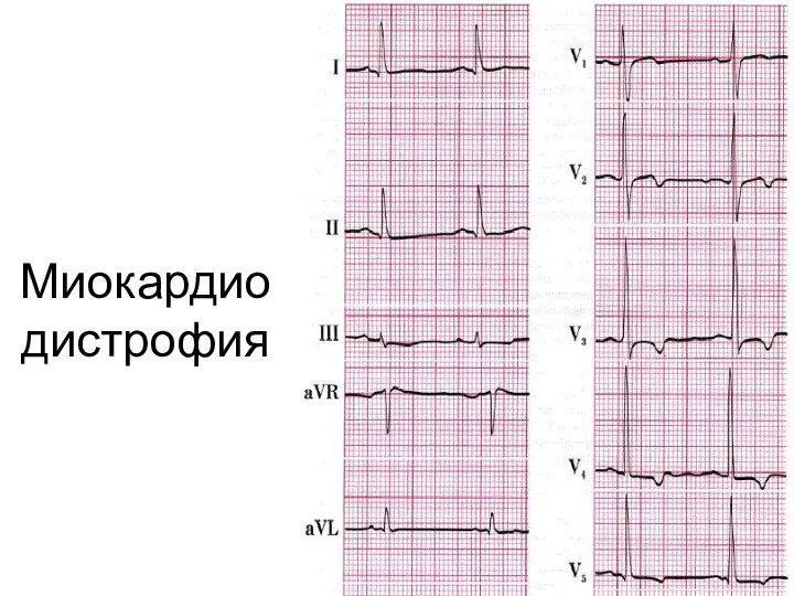 Миокардиодистрофия