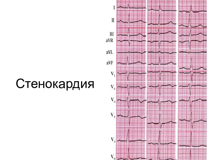 Стенокардия