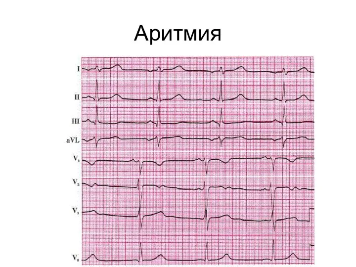 Аритмия