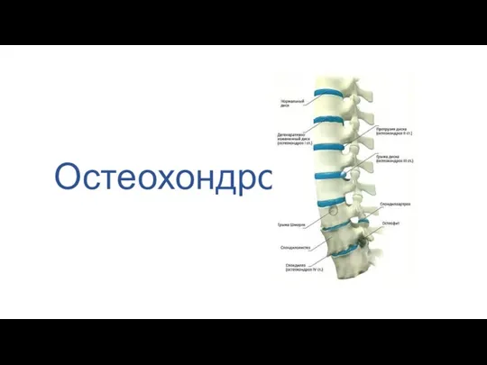 Остеохондроз