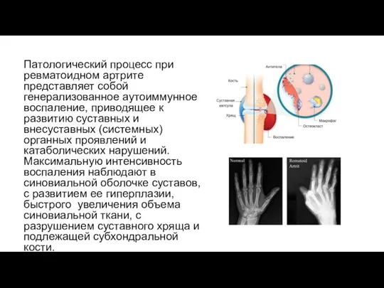 Патологический процесс при ревматоидном артрите представляет собой генерализованное аутоиммунное воспаление, приводящее к