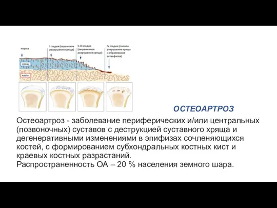 ОСТЕОАРТРОЗ Остеоартроз - заболевание периферических и/или центральных (позвоночных) суставов с деструкцией суставного