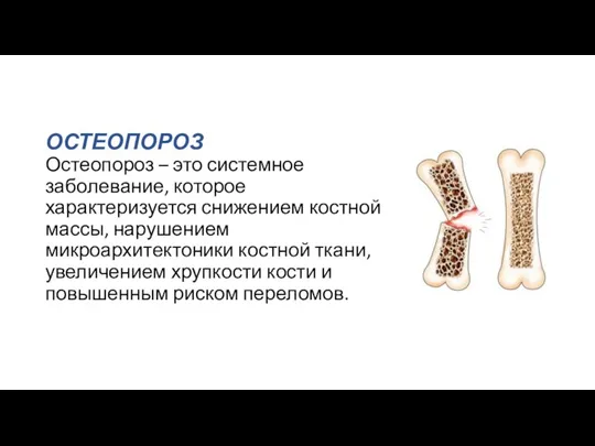 ОСТЕОПОРОЗ Остеопороз – это системное заболевание, которое характеризуется снижением костной массы, нарушением