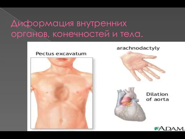 Диформация внутренних органов, конечностей и тела.