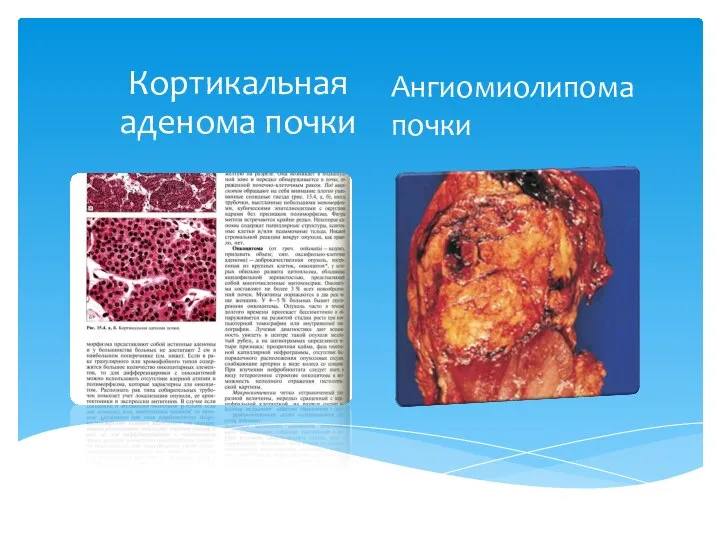 Ангиомиолипома почки Кортикальная аденома почки