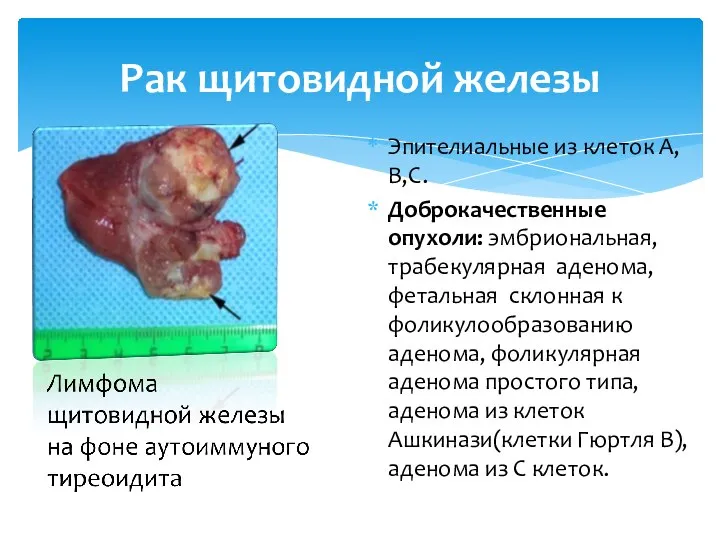 Эпителиальные из клеток А,В,С. Доброкачественные опухоли: эмбриональная, трабекулярная аденома, фетальная склонная к