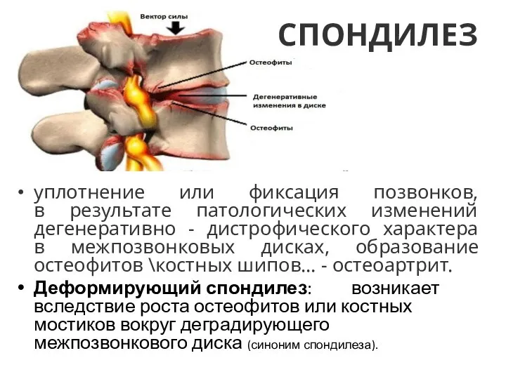 СПОНДИЛЕЗ уплотнение или фиксация позвонков, в результате патологических изменений дегенеративно - дистрофического