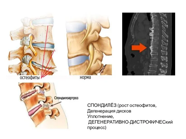 СПОНДИЛЁЗ (рост остеофитов, Дегенерация дисков Уплотнение, ДЕГЕНЕРАТИВНО-ДИСТРОФИЧЕСкий процесс)