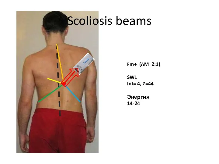 Scoliosis beams Fm+ (AM 2:1) SW1 Int= 4, Z=44 Энергия 14-24