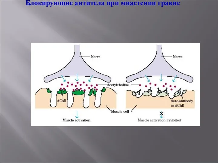 Блокирующие антитела при миастении гравис