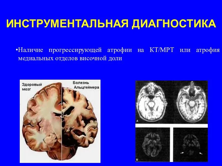 Наличие прогрессирующей атрофии на КТ/МРТ или атрофия медиальных отделов височной доли ИНСТРУМЕНТАЛЬНАЯ ДИАГНОСТИКА