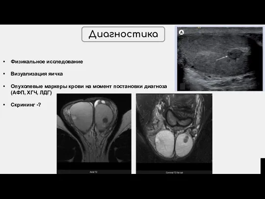 Диагностика Физикальное исследование Визуализация яичка Опухолевые маркеры крови на момент постановки диагноза