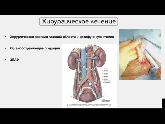 Хирургическое лечение Хирургическая ревизия паховой области и орхифуникулэктомия Органосохраняющие операции ЗЛАЭ