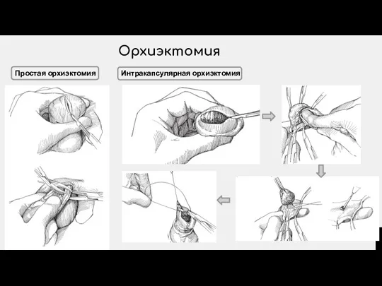 Орхиэктомия Простая орхиэктомия Интракапсулярная орхиэктомия