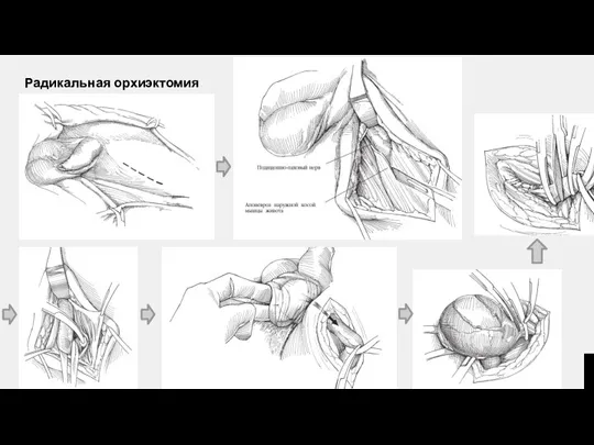 Радикальная орхиэктомия