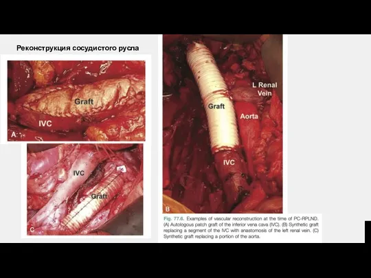 Реконструкция сосудистого русла