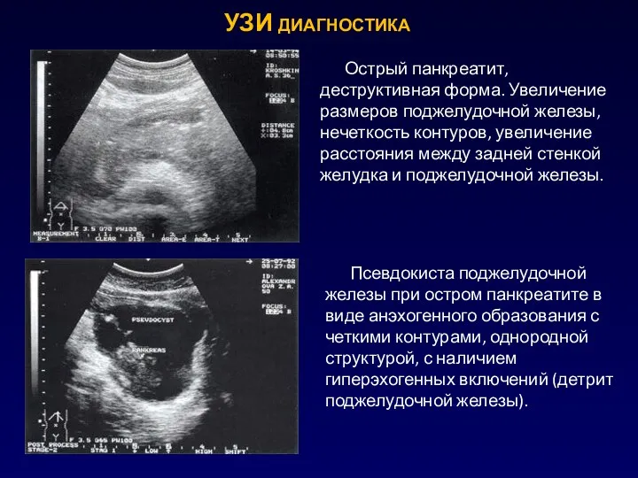 УЗИ диагностика Острый панкреатит, деструктивная форма. Увеличение размеров поджелудочной железы, нечеткость контуров,