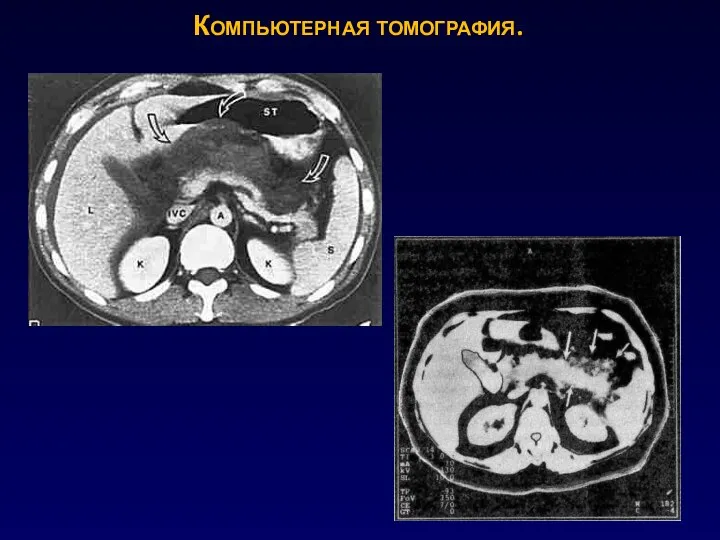 Компьютерная томография.