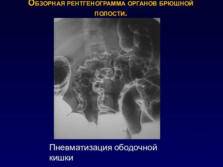 Обзорная рентгенограмма органов брюшной полости. Пневматизация ободочной кишки