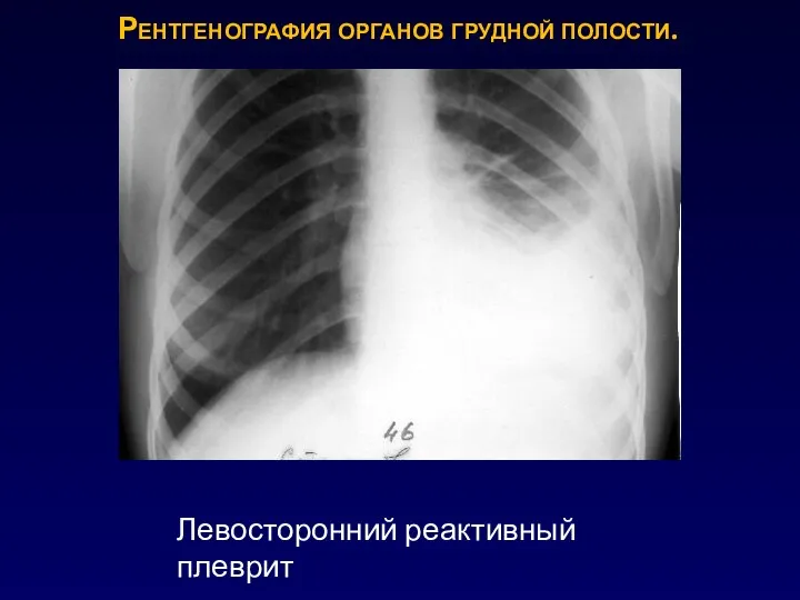 Рентгенография органов грудной полости. Левосторонний реактивный плеврит