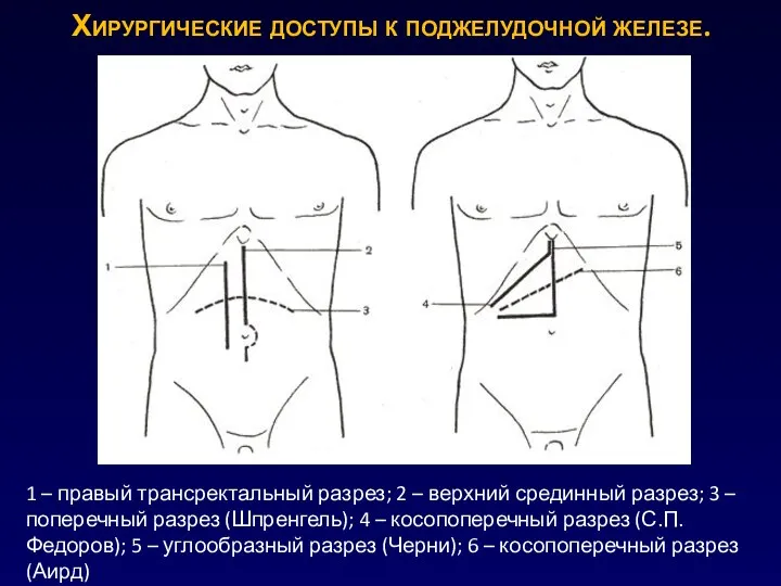 Хирургические доступы к поджелудочной железе. 1 – правый трансректальный разрез; 2 –