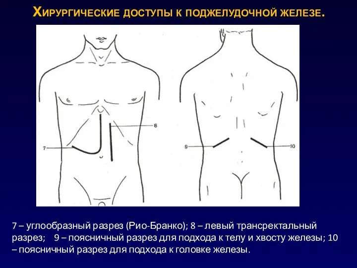 Хирургические доступы к поджелудочной железе. 7 – углообразный разрез (Рио-Бранко); 8 –