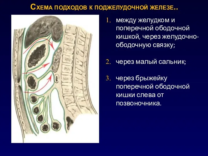 Схема подходов к поджелудочной железе.. между желудком и поперечной ободочной кишкой, через