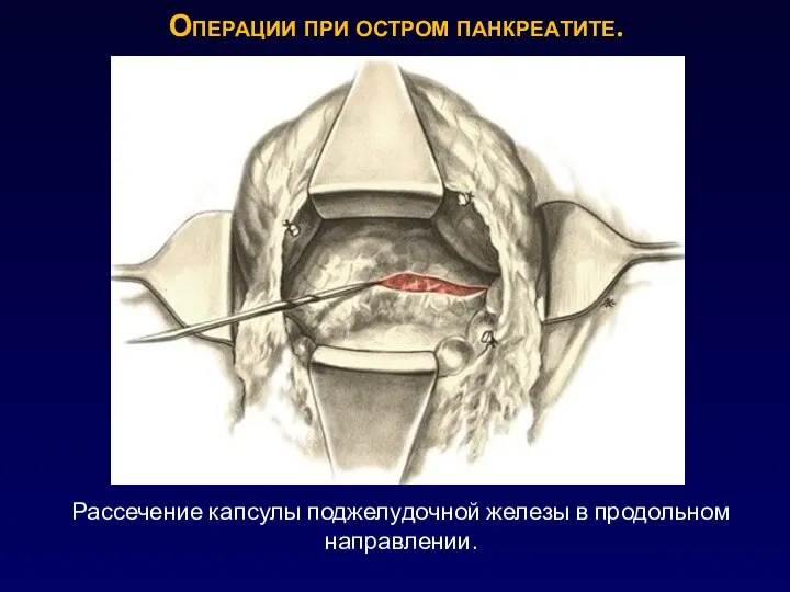 Операции при остром панкреатите. Рассечение капсулы поджелудочной железы в продольном направлении.
