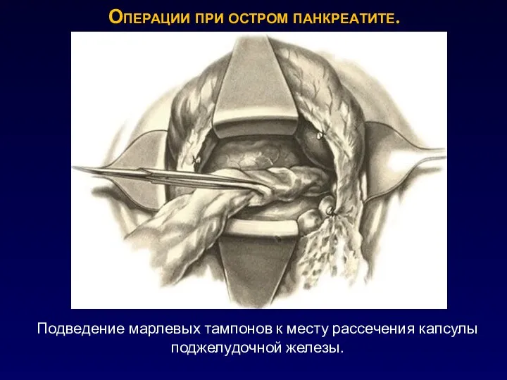 Операции при остром панкреатите. Подведение марлевых тампонов к месту рассечения капсулы поджелудочной железы.