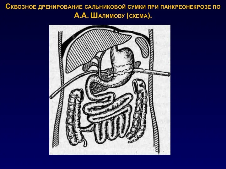 Сквозное дренирование сальниковой сумки при панкреонекрозе по А.А. Шалимову (схема).