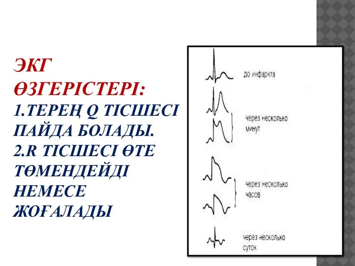 ЭКГ ӨЗГЕРІСТЕРІ: 1.ТЕРЕҢ Q ТІСШЕСІ ПАЙДА БОЛАДЫ. 2.R ТІСШЕСІ ӨТЕ ТӨМЕНДЕЙДІ НЕМЕСЕ ЖОҒАЛАДЫ.