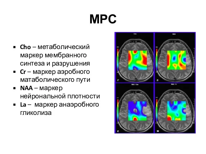 МРС Cho – метаболический маркер мембранного синтеза и разрушения Cr – маркер