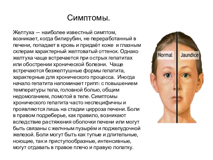 Симптомы. Желтуха — наиболее известный симптом, возникает, когда билирубин, не переработанный в