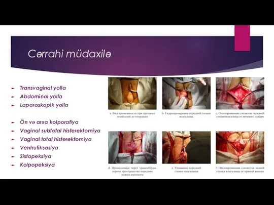 Cərrahi müdaxilə Transvaginal yolla Abdominal yolla Laparoskopik yolla Ön və arxa kolporafiya